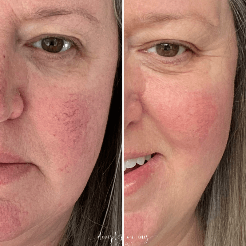 Everything you want to know about Laser therapy for rosacea using Laser Genesis and Excel V Plus laser by Cutera.   #rosacea #rosaceatreatment #lasertreatmentforface