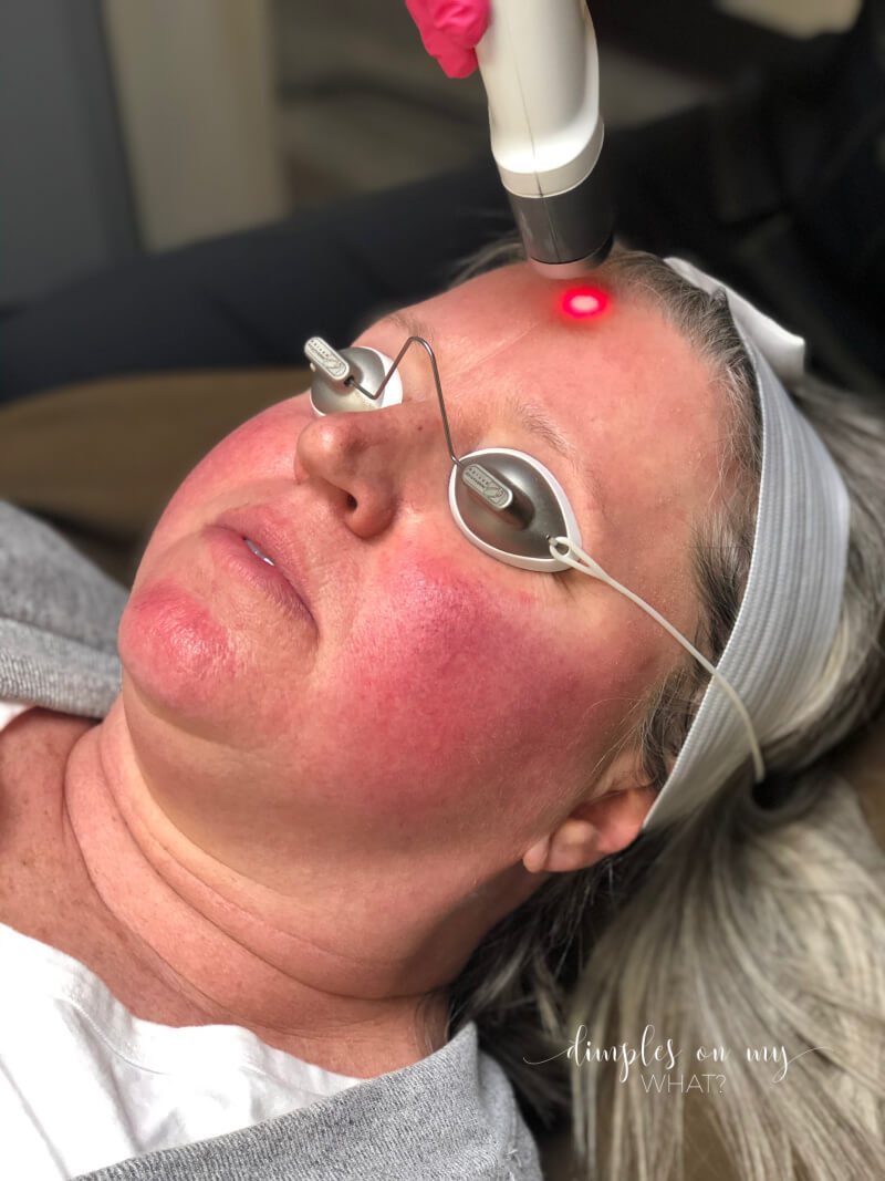 Everything you want to know about Laser therapy for rosacea using Laser Genesis and Excel V Plus laser by Cutera.   #rosacea #rosaceatreatment #lasertreatmentforface