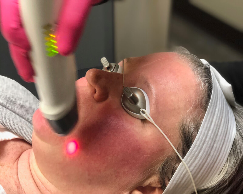 Every thing you want to know about laser treatment for rosacea. 