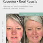 Every thing you want to know about laser treatment for rosacea using Laser Genesis and Excel V Plus laser therapy. See before and after photos