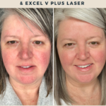 Every thing you want to know about laser treatment for rosacea using Laser Genesis and Excel V Plus laser therapy. See before and after photos of the results from my own laser therapy