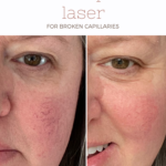 Every thing you want to know about laser treatment for rosacea using Laser Genesis and Excel V Plus laser therapy. See before and after photos of the results from my own laser therapy for rosacea.